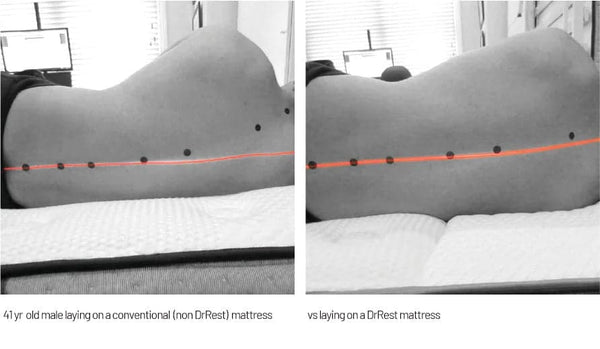 Revolutionising Sleep Apnoea Treatment: How the DrRest Mattress is Transforming Restful Sleep